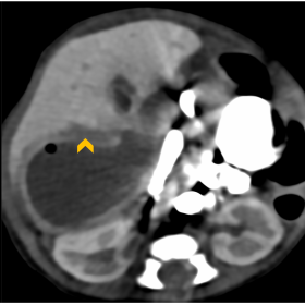Axial CECT images showing a well-encapsulated lesion in right lobe of liver with internal air foci (arrow) and perilesional oedema (arrowhead), extending along subcapsular surface medially. Significant artefacts from oral contrast are seen. Coronal image showing a tubular structure extending from the collection inferiorly into right paracolic gutter, which was thought to be localized perforation (curved arrow).