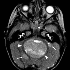 Brain MRI T2-weighted image showing three intraparenchymal expansile lesions in the cerebellum, the largest in the vermis (arrowheads) and the smaller ones in the cerebellar hemispheres (arrows).