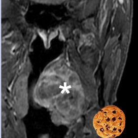 Coronal T1W FS CE image shows heterogeneous enhancement corresponding to the presence of dense collagenous areas, providing a “chocolate-chip cookie” appearance.