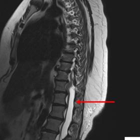 Sagittal T2-MRI shows a large, well-defined extradural CSF signal intensity lesion at D11–L3 level, anteriorly displacing and compressing the cord and cauda equina nerve roots (red arrow).