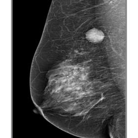2D oblique view, demonstrating a well-circumscribed and dense ovoid nodule in the axillary tail of the right breast.