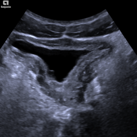 Sagittal ultrasound image of the bladder showing severe bladder wall thickening, which results in restriction of bladder dist