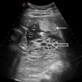 Transverse greyscale ultrasound image showing a multicystic intrauterine mass (open arrow), based along the posterior wall an