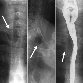 Radiographs showing a thin wall air cyst located right posterolateral to the trachea, at the level of the thoracic inlet. Con