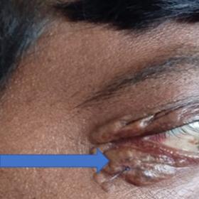 Xanthelasma involving the right eye, indicated by the thick blue arrow.