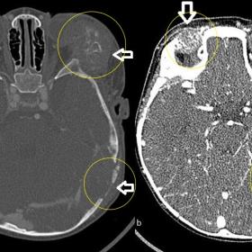 Metastases in the cranium. Lytic lesions and descriptive radial periosteal reaction are seen in the outer and lateral parts of both orbits (a and b, arrows and circles). Dural involvement is observed adjacent to the lytic lesion in the left occipital and temporal bone (b, arrows and circles).