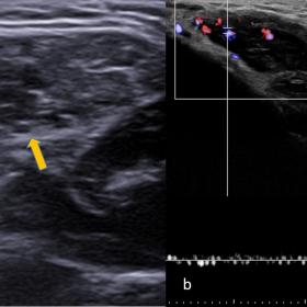 (a) USG of the left cheek showing an ill-defined hypoechoic lesion with few cystic areas (bold arrow) within the masseter muscle (star) and echogenic foci with posterior acoustic shadowing likely phleboliths (arrowhead). (b) Mild vascularity detected on power Doppler setting with slow flow venous waveform.