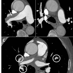 Axial CTPA images in a patient with CTEPH: a large eccentric thrombus in the right pulmonary artery (arrow on A) and multiple