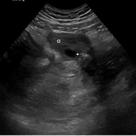(a) Ultrasound image showing a normal-sized left ovary (o) with some follicles (white arrow) within it. (b) Ultrasound image showing a complex heterogeneous lesion (between callipers) with solid and cystic areas, posterior to the left ovary. It contacts with the posterolateral side of the uterine fundus and does not have vascularisation on colour Doppler. There is also hyperechogenicity of the surrounding fat.