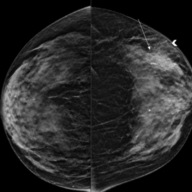 Craniocaudal (CC) and mediolateral oblique (MLO) synthetic 2D images of the mammographic study demonstrate a focal asymmetry 