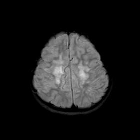 Axial FLAIR image showing confluent fluffy and poorly demarcated FLAIR hyperintensities in bilateral frontoparietal subcortic