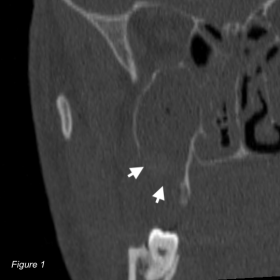CT coronal bone reconstruction demonstrating a post-extraction maxillary tuberosity defect (white arrows).