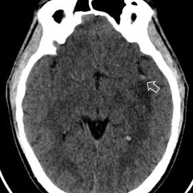 Computed tomography (CT) of the brain reveals a punctate subarachnoid haemorrhage in the left lateral fissure.