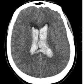 Brain CT scan without contrast shows a massive bilateral intraventricular haemorrhage.