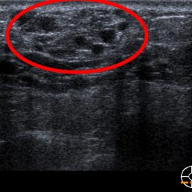 Superficial heterogeneous solid mass/nodule in the inner lower quadrant of the left breast (red circle).