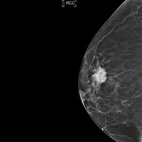 Right 2D mammography (a) caudal cranial and (b) mediolateral oblique showing a high-density spiculated mass with associated microcalcifications in the upper outer quadrant (UOQ).