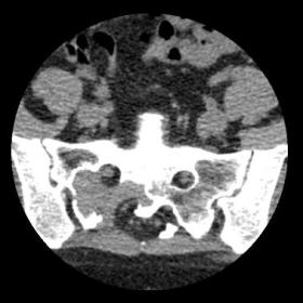 Axial CT soft-tissue window in sacroiliac region. A lytic lesion in the right part of the sacrum with soft tissue density is 