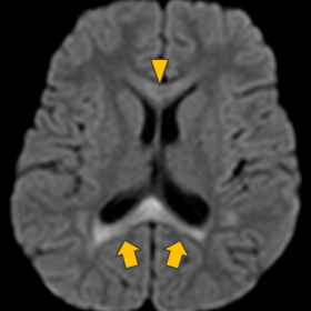 Axial DWI showing significant restricted diffusion with hyperintensity in the splenium of the corpus callosum (“Boomerang s