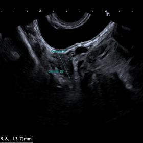 Transvaginal ultrasound. Provides a clearer view of the lesion, measuring 10.6 x 10.8 x 9.9 cm (diameters: transverse, anteroposterior, and craniocaudal). Only one ovary was identified in the pelvis, which was reported as the right ovary.