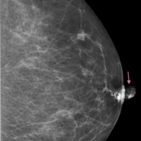 Craniocaudal (A) and mediolateral (B) galactograms of the left breast showing a lobulated retroareolar filling defect extending into the nipple, measuring 16x8 mm (arrow)