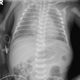 Chest radiograph shows levocardia with cardiomegaly, increased pulmonary vascular markings and airspace opacities, indicative of pulmonary oedema.