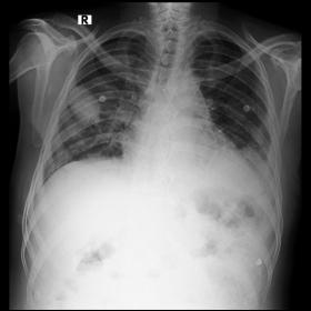 Chest X-ray AP view shows inhomogeneous opacities in the right mid zone, bilateral basal zones and left pleural effusion