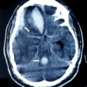 Axial CT scan brain showing subdural, subarachnoid and intraventricular dissection of hemorrhage (arrows).