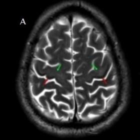 Axial T2 (a, b) and FLAIR (c, d) images show hyperintensity in the subcortical white matter of the motor cortex (green arrow)