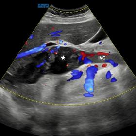 Longitudinal ultrasound Doppler of the supra-adrenal segment of the IVC. The image shows a mixed echogenic occlusive and expa