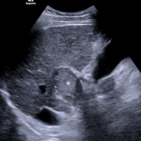 B-mode image showing the enlarged portal vein filled with echogenic material (asterisk).