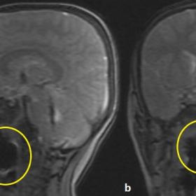 Cranial MRI scout scans in sagittal and coronal planes show artefact and a signal-free area in the nasopharynx (yellow circle