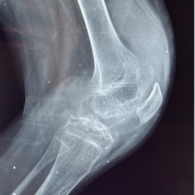 Left knee lateral X-ray: Irregularity of articular surfaces with narrowing of the femorotibial joint; Peri-articular density.