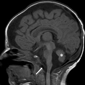 Sagittal T1 weighted image of brain showing vermian hypoplasia (*) with dilated fourth ventricle small pontine bulge. The ima