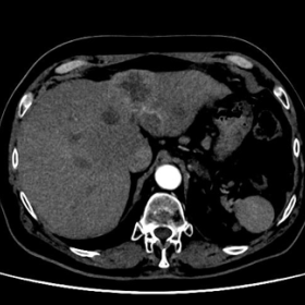 Axial CT image showing an infiltrative hypodense lesion in the right hepatic lobe.