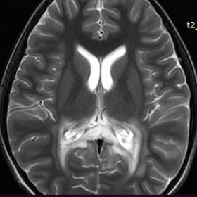 Brain axial T2 image, showing hyperintensity in the posterior periventricular region, splenium of the corpus callosum and posterior limb of the internal capsule.