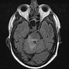 MRI FLAIR (1a), MRI T2 axial (1b), MRI DWI (1c), MRI ADCmap (1d): Mixed vasogenic and cytotoxic oedema involving the rostral midbrain and the cerebellum, spanning different arterial territories, can be visualised in the initial scan.