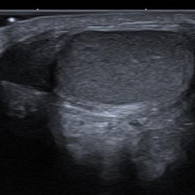 Ultrasound of the right hemiscrotum shows normal appearances with a single testicle and epididymis of normal echogenicity.
