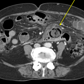 Portal venous phase axial CT showing outpouching round thick walled fluid or gas-containing structures present outside the lu