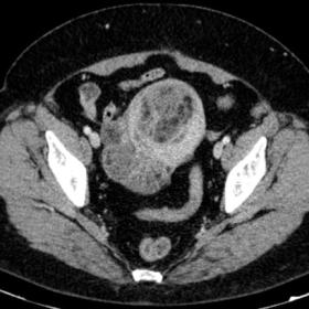 Axial contrast-enhanced CT image illustrates uterine masses characterised by central macroscopic fat.