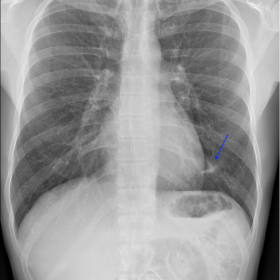 Chest radiograph – an oval opacity, with irregular borders, is seen in the left lower lobe.