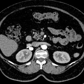 Axial acquisition contrast-enhanced computed tomography (CT) showed a saccular aneurysm of 13 mm in diameter, without thrombi