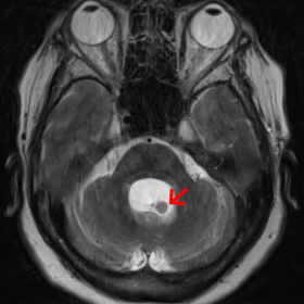 Axial T2-weighted image. Focal lesion with heterogeneous signal and solid-multicystic appearance occupying the fourth ventricle, with eccentric left hypointense nodular image suggestive of the scolex (arrow).