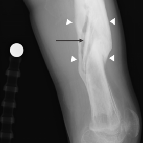 Plain radiography, anteroposterior and lateral views. Signs of diaphyseal fracture with malalignment, associated with exuberant periosteal reaction and bone sclerosis – involucrum (arrowheads). A sclerotic bone fragment is visible in the medullary cavity (arrow), surrounded by a lucent rim.