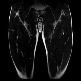 Coronal T2-weighted fat-suppressed imaging (Dixon sequence) showing the superior cleft sign on the right side of the pubic joint.