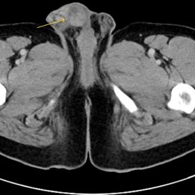 Axial contrast CT (portal venous phase) of a significantly enlarged right testicle with an inhomogeneous contrast enhancement (arrow).