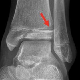 Conventional X-ray of the ankle, mortise view. Oblique fracture in the distal tibial epiphysis and passing through the growth plate. Notice the slight physeal broadening (arrows) and the subtle osseous rarefaction on the lateral aspect of the tibial metaphysis, suspicious of transphyseal extension of the fracture in keeping with a Salter–Harris fracture type III.