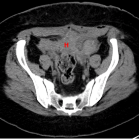 Axial CT images depict hemoperitoneum (H in 1a). Axial CT images in the arterial phase show a contrast ex in the right iliac fossa (red arrow in 1b) that increases on axial CT images in the portal venous phase (blue arrow in 1c).