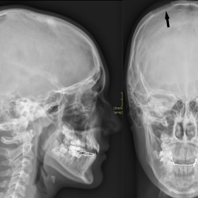Plain radiographs. Lateral view (left) and AP view (right) of the head showing the 2.5 cm big osteolytic defect in the parietal bone (arrow) with a relatively well-defined rim and no sclerosis.