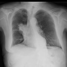 Chest X-ray in PA projection (1a) shows a right hilar mass with surrounding opacity and peripheral tracts. Lateral projection (1b) denotes a mass location in the upper right lobe and a minimal pleural effusion.
