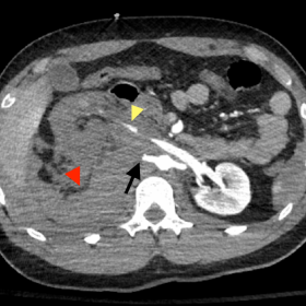Initial axial (a) and coronal (b) contrast CT of abdomen and pelvis. Show avulsion of the right renal artery (black arrow), with evidence of small contrast extravasation (yellow arrowhead) and significant retroperitoneal haematoma (red arrowhead) causing significant anterior displacement of the right kidney. Additionally, there is liver injury with significant perihepatic and retroperitoneal haemorrhage.